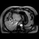 Adenocarcinoma of gallbladder, fistula to colon: MRI - Magnetic Resonance Imaging